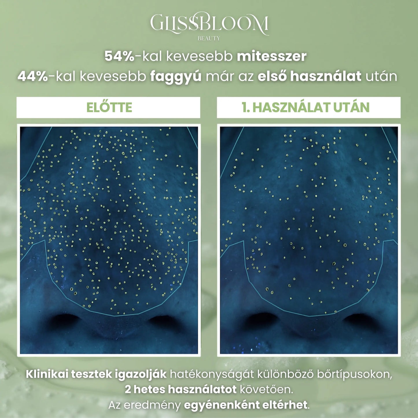 Viszlát mitesszerek: Mélypórus tisztítás a GlissBloom erejével.